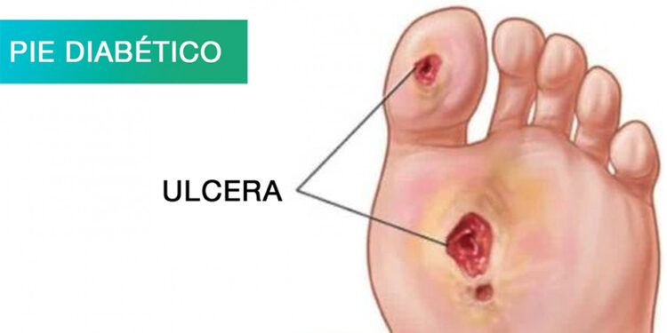 Las heridas por trauma y las úlceras de pie diabético representan la mayor demanda en atención médica